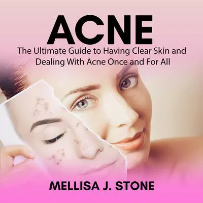 Acne: The Ultimate Guide to Having Clear Skin and Dealing With Acne Once and For All Audibook, by Mellisa J. Stone